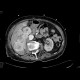 Renal cell carcinoma, recurrence, metastases: CT - Computed tomography